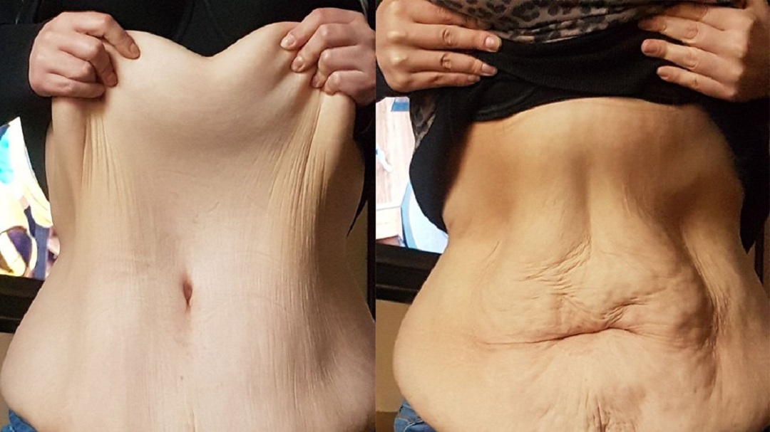 How to Prevent Loose Skin During Weight Loss
